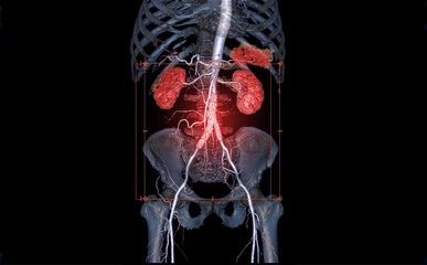CTA Whole Aorta 3D rendering .