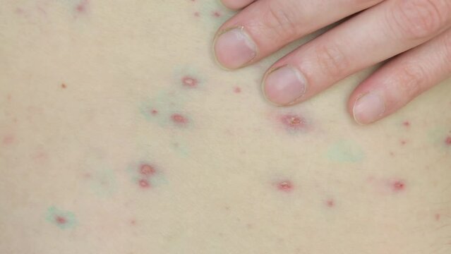 Body of adult man have spotted, red pimple and bubble rash from monkeypox or varicella zoster virus