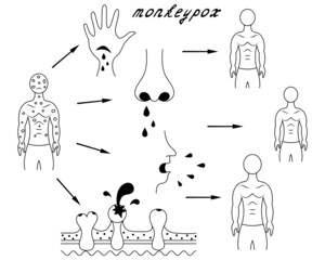 Methods of human infection with monkeypox. Diagram of human-to-human transmission of smallpox. Sketch. In contact with body fluids, damaged skin, secretions from pustules. Vector illustration. 