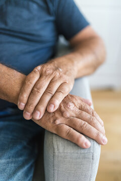 Elderly man suffering from psoriasis on hands