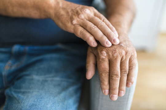 Elderly man suffering from psoriasis on hands