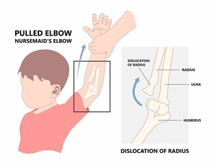 Child elbow dislocated injury that cause ulna bone fracture nursemaid painful head of radius subluxation young slight bend - obrazy, fototapety, plakaty