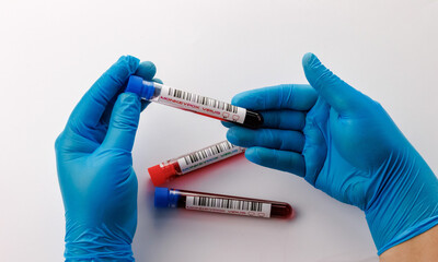 flasks with blood tests for monkey pox virus positive and negative
