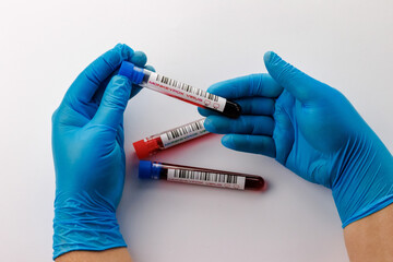 flasks with blood tests for monkey pox virus positive and negative