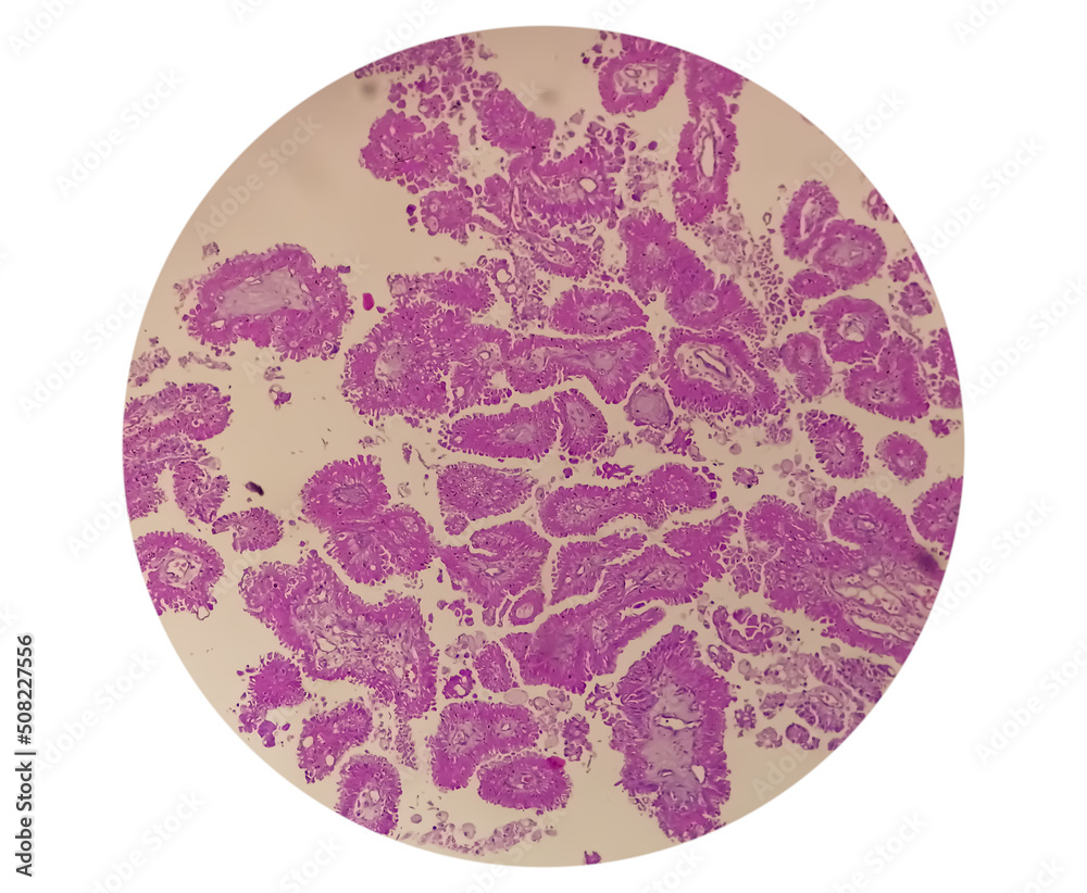 Wall mural Histology of metastatic papillary adenocarcinoma.