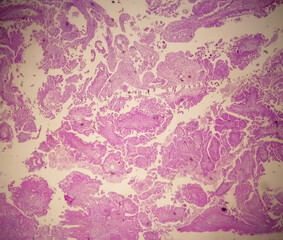 Fototapeta na wymiar Histology of metastatic papillary adenocarcinoma.