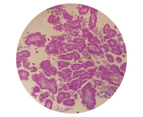Histology of metastatic papillary adenocarcinoma.