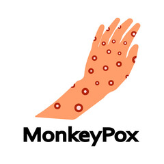 Monkeypox virus. Eruption on the body. Monkey Pox virus disease symptoms on hands rash infection. Vector illustration isolated