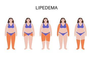 Lipedema fat zones