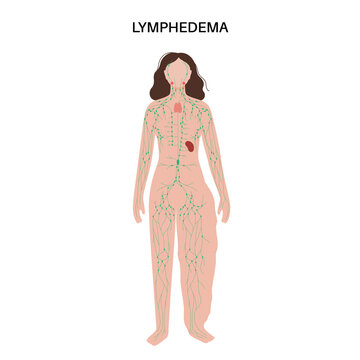 Lymphedema leg swelling