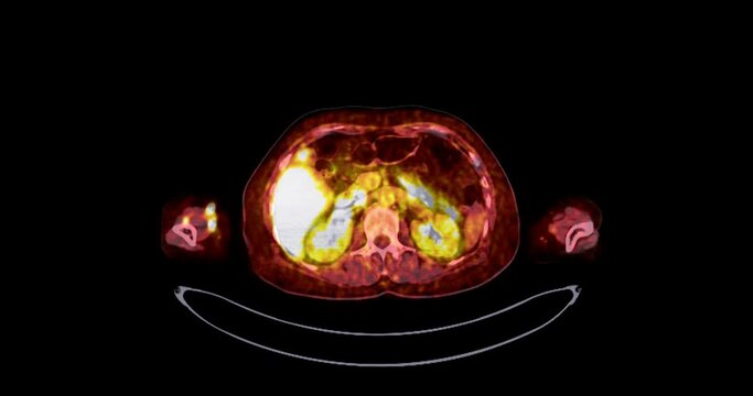  PET CT ( Positron Emission Tomography )  of whole human body 3d rendering image red color tone axial view for detect tumor recurrence after surgery.