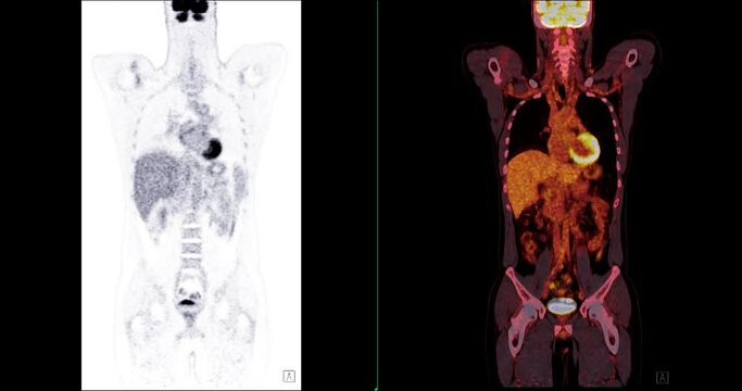  PET CT ( Positron Emission Tomography )  of whole human body 3d rendering image red color tone axial view for detect tumor recurrence after surgery.