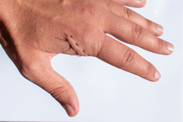Hand injured by a cut. Surgical suture made by a surgeon. Cut in the hand with knife, scissors,...