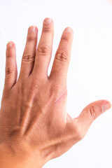 Hand injured by a cut. Surgical suture made by a surgeon. Cut in the hand with knife, scissors,...