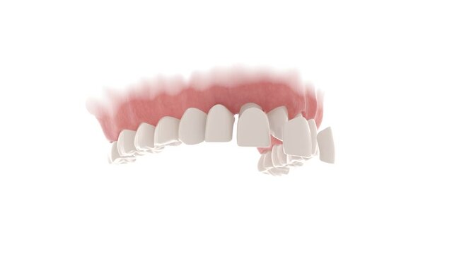 3d animation of placement dental veneers over lateral and central incisors