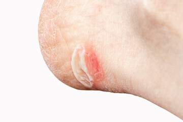 Foot with callus on a white background, close-up. Red sore on leg from wearing shoes. Bloody callus on the heel.