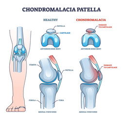 Chondromalacia patella knee breakdown compared with healthy outline diagram. Labeled educational kneecap tissue damage with cartilage problem and anatomical leg joint structure vector illustration. - obrazy, fototapety, plakaty