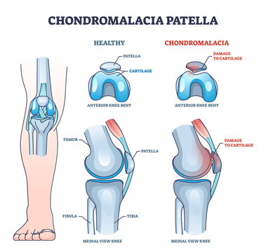 Chondromalacia patella knee breakdown compared with healthy outline diagram. Labeled educational kneecap tissue damage with cartilage problem and anatomical leg joint structure vector illustration.