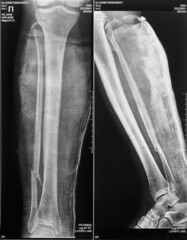 Radiograph of a comminuted fracture of the lower leg with displacement and in two projections,...