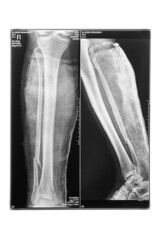 X-ray of a comminuted fracture of the lower leg with displacement and in two projections, on a white background. vertical image