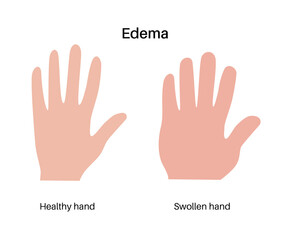Edema of arm