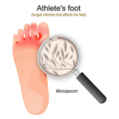 Athlete's foot. fungal infection of Microsporum - obrazy, fototapety, plakaty