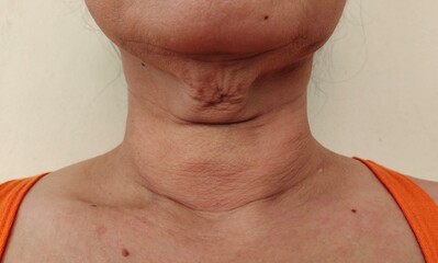 portrait showing the flabbiness adipose hanging skin under the neck, problem wrinkles and flabby skin under the chin of the woman, concept health care.