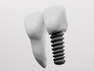 central, diente, sonrisa, implante, implantes dentales, odontología, implantologia, estética dental, corona, cad cam, odontología digital, prótesis dental, dentista, odontólogo, muelas, molares, carie
