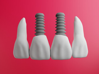 Odontologia Implantes - obrazy, fototapety, plakaty