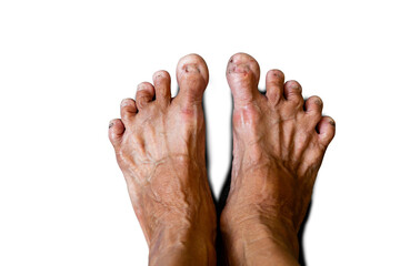 Obraz premium Old people's feet with fungal nails. foot screening test, diabetes health promotion