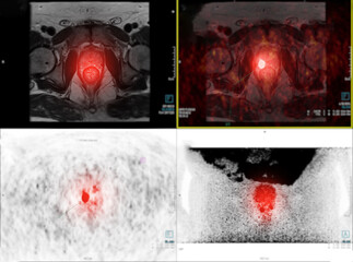 PET/MRI prostate gland  .