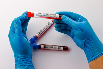 flasks with blood tests for monkey pox virus positive and negative