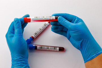 flasks with blood tests for monkey pox virus positive and negative