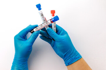 flasks with blood tests for monkey pox virus positive and negative, Monkeypox virus, is a double-stranded DNA, zoonotic virus and a species of the genus Orthopoxvirus in the family Poxviridae