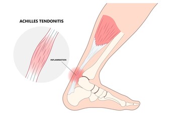 Inflammation of Achilles tendon injury Feet calf test range of motion slight ache problem limb Thompson Simmonds and torn Rupture  - obrazy, fototapety, plakaty