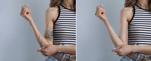 Woman before and after laser tattoo removal procedure on light grey background, closeup. Collage...