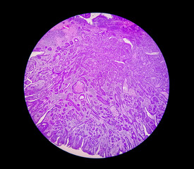 Histological slide under microscopy showing Pedunculated squamous papilloma.