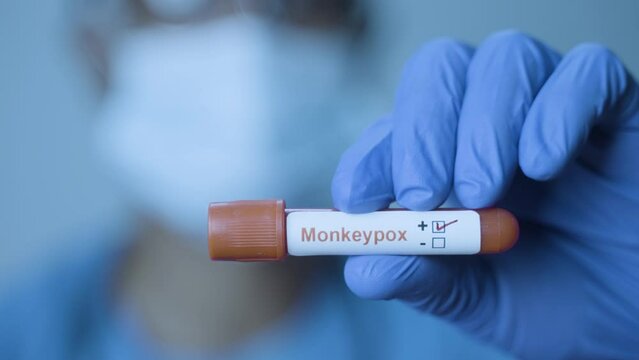 close up rack focus shot of doctor showing Monkeypox positive test of laboratory blood sample - concept of virus outbreak or spreading infection
