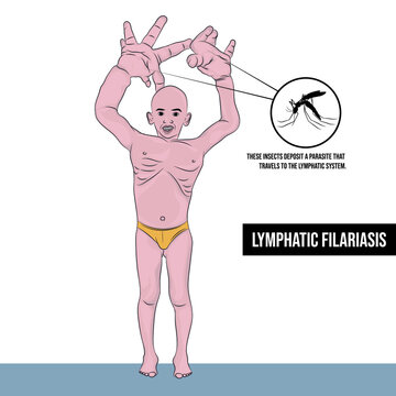 Lymphatic filariasis or elephantiasis is spread by infected mosquitoes, infecting the skin and lymphatic tissue.