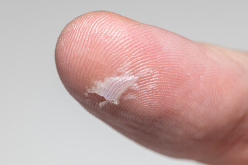 A burst blister on the thumb of a Caucasian man. Mechanical damage to the skin on the thumb of a man. Dermatological problem