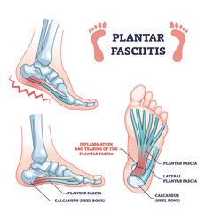 Plantar fasciitis as fascia muscle inflammation and tearing outline diagram. Labeled educational scheme with painful foot condition and medical xray explanation vector illustration. Feet skeleton.