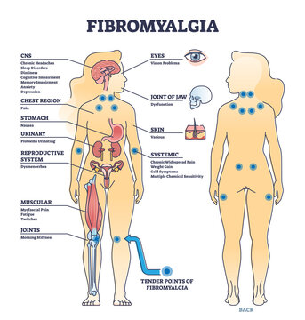 Fibromyalgia as musculoskeletal pain disorder tender points outline diagram. Labeled educational scheme with widespread medical body problems from FMS condition vector illustration. Symptoms list.