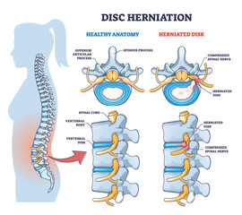 Disc herniation or spine nerve compression vs healthy anatomy outline diagram. Labeled educational scheme with superior articular process and herniated disk vector illustration. Vertebral body trauma. - obrazy, fototapety, plakaty