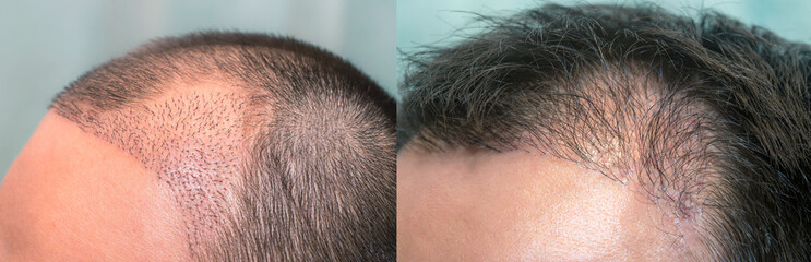 Close up top view of a man's head with hair transplant surgery with a receding hair line. -  1-5 months after Bald head of hair loss treatment. - obrazy, fototapety, plakaty