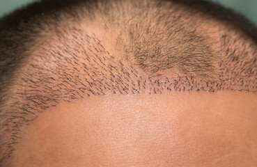 Close up top view of a man's head with hair transplant surgery with a receding hair line. - obrazy, fototapety, plakaty