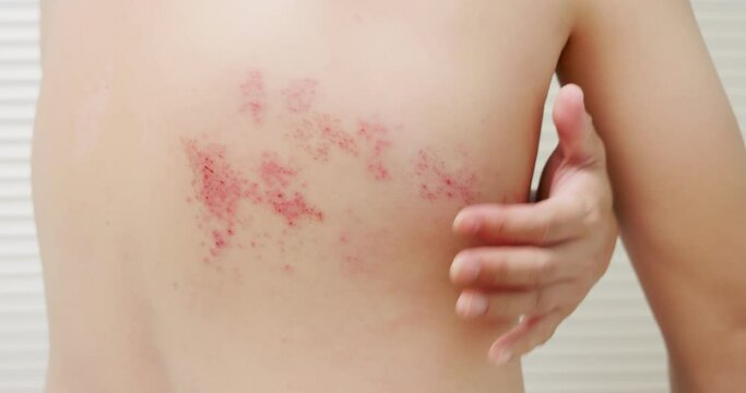 man with shingles disease