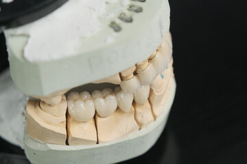 Metal free ceramic dental crowns.  Dental ceramic bridge on isolated wite background. Closeup ceramic to dental implants in laboratory.