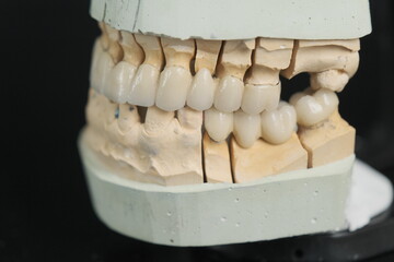 Metal free ceramic dental crowns.  Dental ceramic bridge on isolated wite background. Closeup ceramic to dental implants in laboratory.