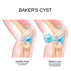 Baker's cyst. Normal knee, and joint with Popliteal cyst
