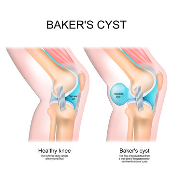 Baker's cyst. Normal knee, and joint with Popliteal cyst